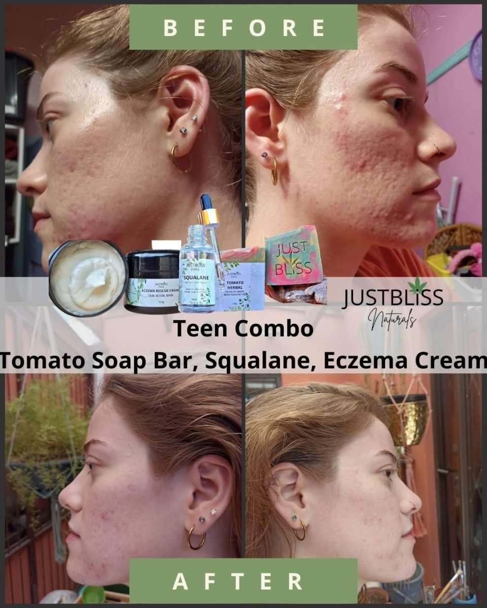 Eczema Rescue Cream – Steroid - Free Relief with CBD & Botanicals JUSTBLiSS Naturals