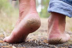 Cracked Heels Are Not Normal: What's Really Happening to Your Feet