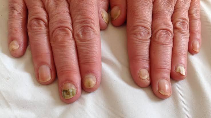 Why Your Nails Won't Heal (And What Actually Works)