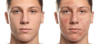 TIPS FOR LOOKING AFTER TEENAGE ACNE AND SPOT-PRONE SKIN - JUSTBLiSS Naturals