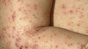 UNDERSTANDING ECZEMA - JUSTBLiSS Naturals