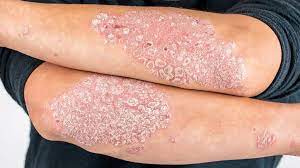 UNDERSTANDING PSORIASIS - JUSTBLiSS Naturals