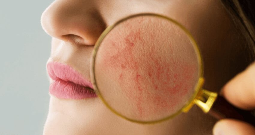 UNDERSTANDING ROSACEA - JUSTBLiSS Naturals