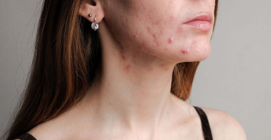 WHAT IS ACNE? - JUSTBLiSS Naturals