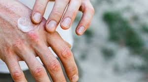 WINTER HANDS & TOES - Are you suffering with this as well? - JUSTBLiSS Naturals