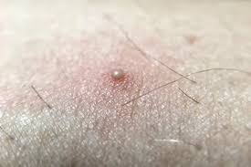 Shaving Bumps & Ingrown Hair
