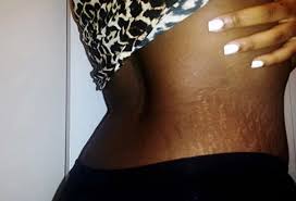 Scars & Stretch Marks