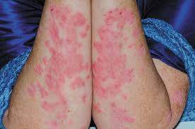 PSORIASIS - JUSTBLiSS Naturals