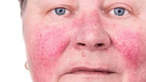 ROSACEA & REDNESS RELIEF - JUSTBLiSS Naturals